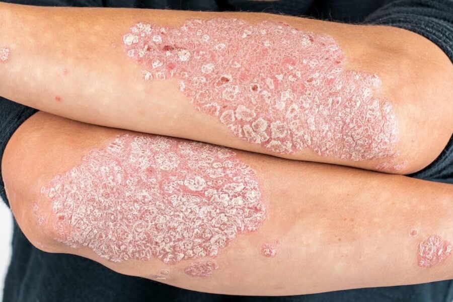 Psoriasi