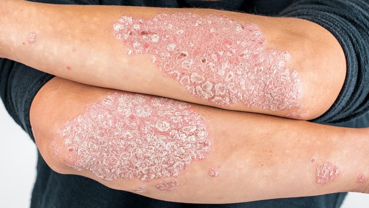 Psoriasi