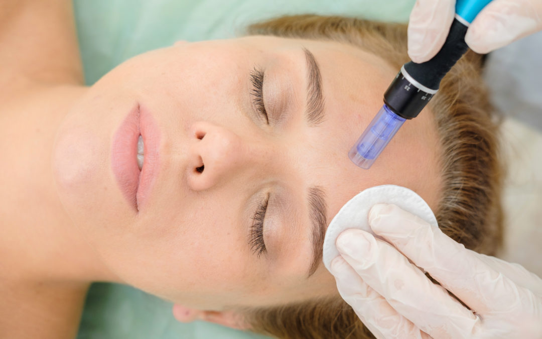 Microneedling