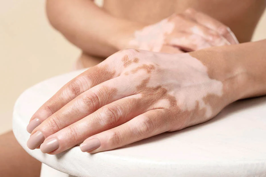 Λεύκη