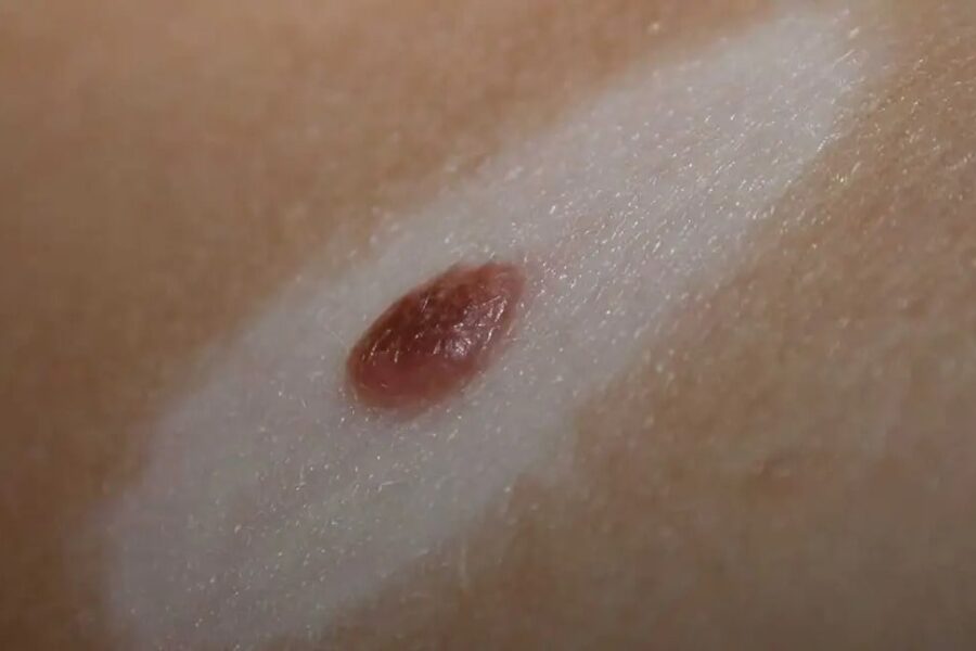 Σπίλος Sutton - Halo Nevus