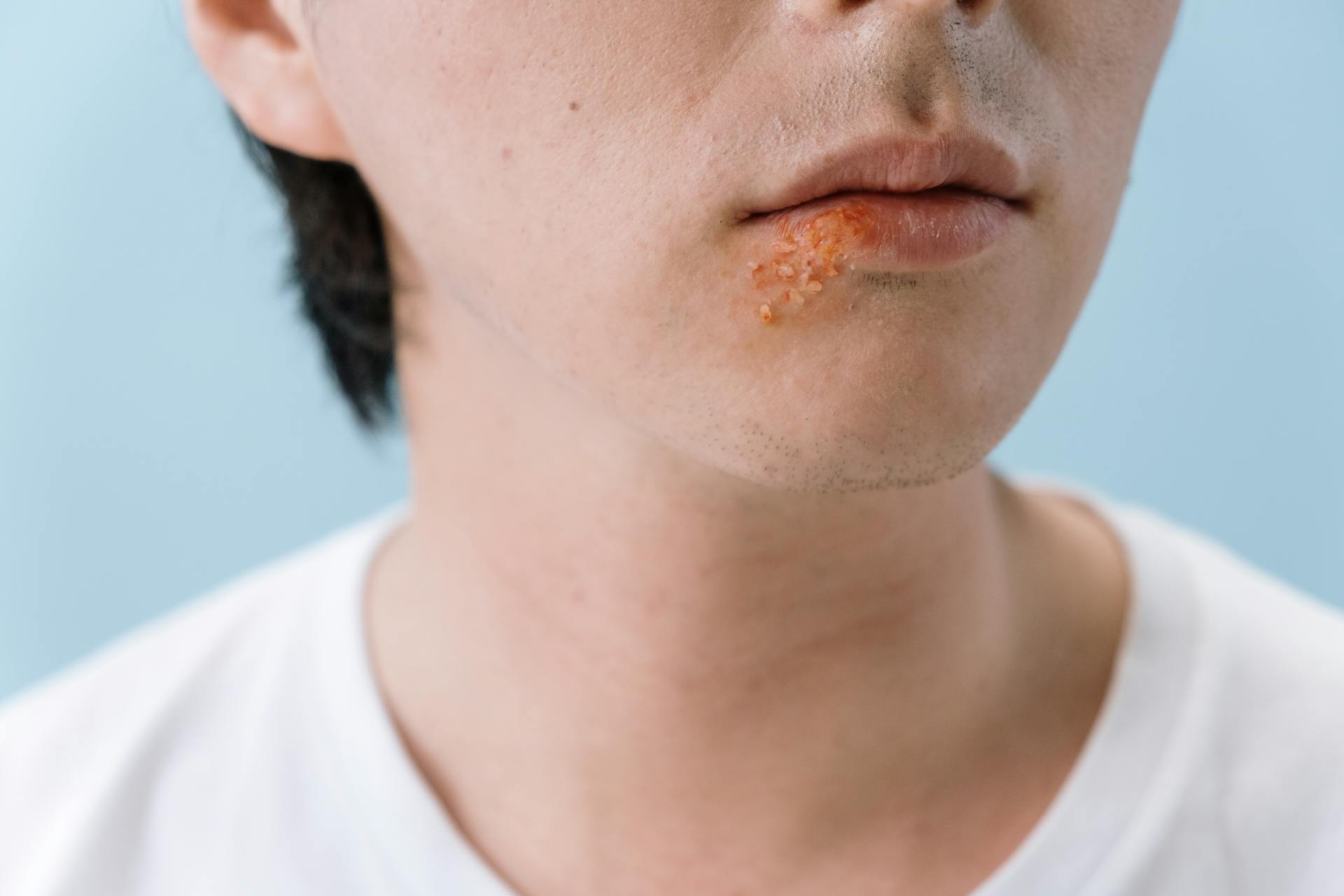 Herpes