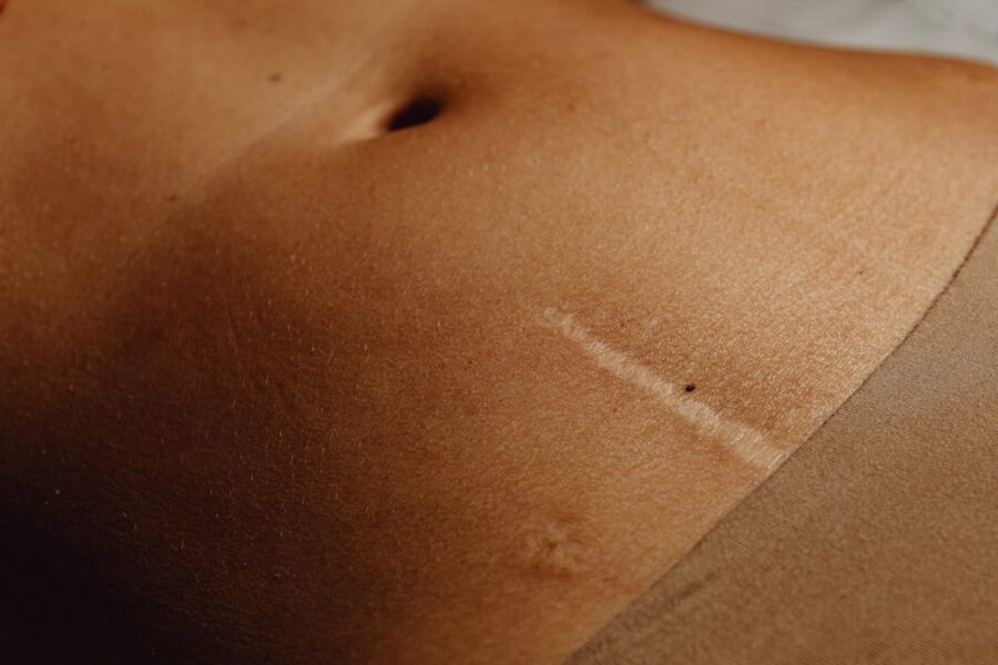 Scar