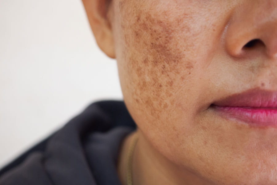 Melasma