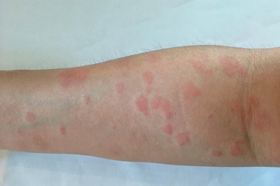 Lupus
