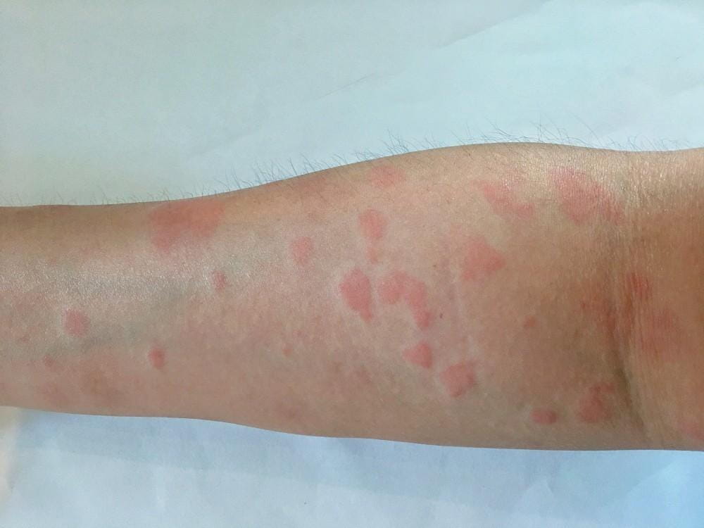 Lupus