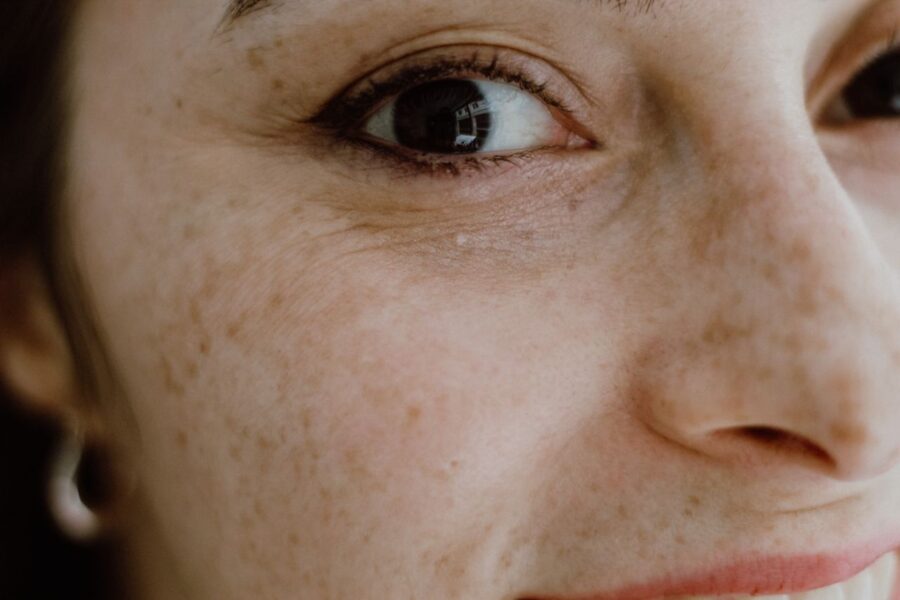 Photoaging