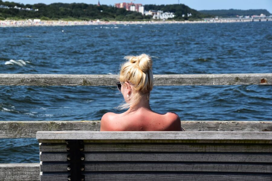 Sun burn