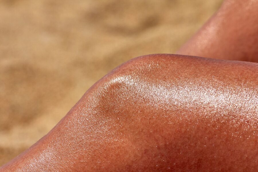 Sunburn