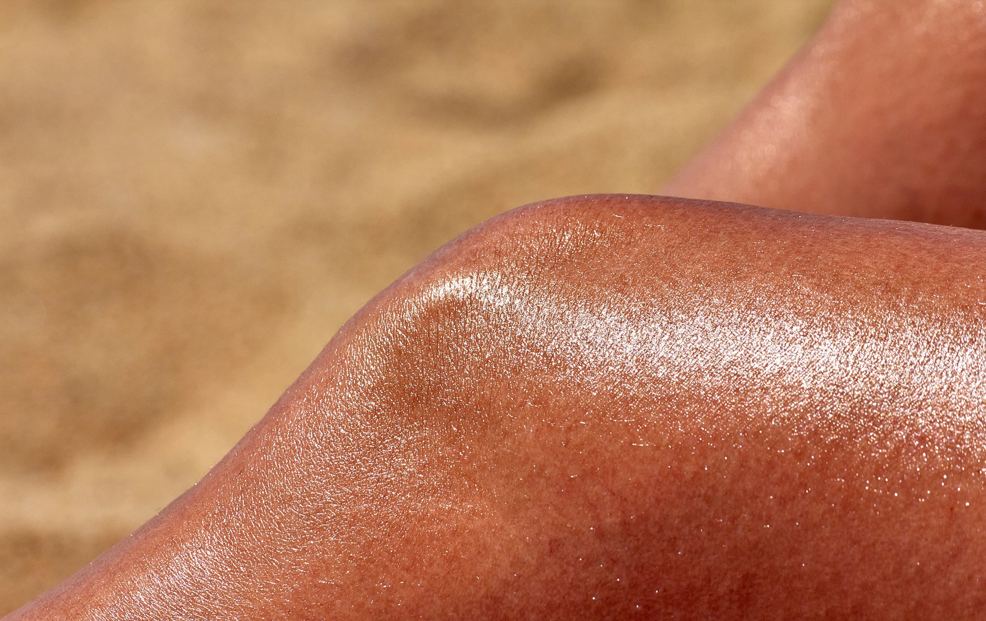 Sunburn